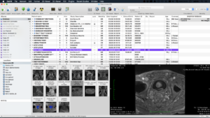 Osirix MD Viewer - Database